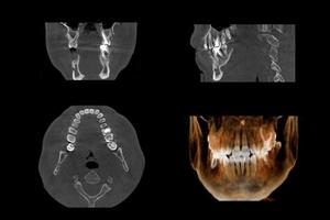reeks van mri scanner plakjes van tandheelkundig een deel van menselijk mannetje wrikken met meerdere problemen Aan wit achtergrond. foto