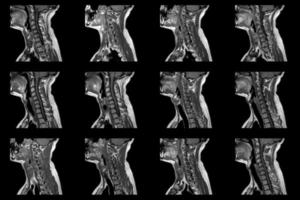 reeks van sagittaal mri scant van nek Oppervlakte van Kaukasisch mannetje met bilateraal paramediaal extrusie van de c6-c7 segment met radiculopathie foto