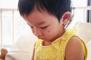 schattig weinig Aziatisch meisje met allergie rood plek Aan gezicht oorzaak door insect beet foto