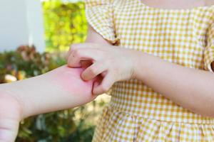 weinig meisje heeft huid uitslag allergie en jeukend Aan haar arm foto