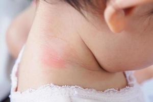 baby huiduitslag en allergie met rode vlek veroorzaakt door muggenbeet in nek foto