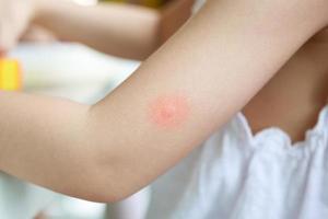 weinig meisje heeft huid uitslag en allergie van mug beet foto