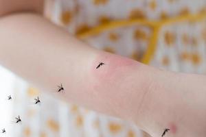 weinig meisje heeft huid uitslag allergie en jeukend Aan haar arm van mug beet foto