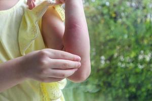 weinig meisje heeft huid uitslag allergie en jeukend Aan haar arm foto