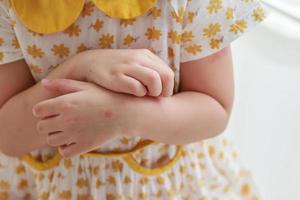 weinig meisje heeft huid uitslag allergie jeuk en krabben Aan haar arm foto