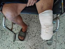 hieronder knie amputatie geduldig met elastisch verband naar bereiden voor been prothese foto