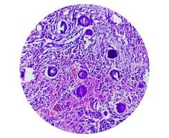 spinal tumor biopsie, psammomateus meningeoom. psammoma lichamen. foto