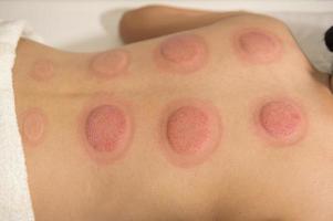 mooi vrouw ontvangen cupping behandeling Aan terug door therapeut, Chinese geneeskunde behandeling, Gezondheid en genezing concept. foto