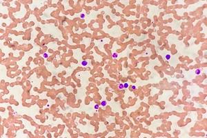 microfoto van hematologische glijbaan tonen monocytose. abnormaal monocyt. foto