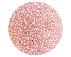 microfoto van hematologische glijbaan tonen monocytose. abnormaal monocyt. foto