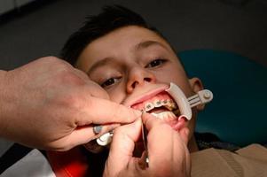 een orthodontist lijmen en vastmaakt een beugel Aan de bovenste tanden van een schooljongen, uitlijnen tanden met een beugel. foto