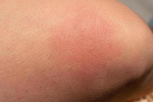 allergie Aan de menselijk lichaam en roodheid van een wesp steek. foto