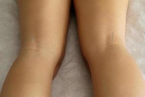 vrouw poten met staal naalden gedurende procedure van acupunctuur behandeling foto