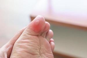 Mens hebben bunion tenen of blaar ten gevolge naar vervelend versmallen schoenen en ontwaken of rennen lange tijd, blootsvoets pijn ten gevolge naar plantaris fasciitis. Gezondheid en medisch concept foto