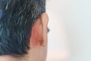 Mens hebben oor problemen ten gevolge naar seborroïsch dermatitis, psoriasis, ringworm en schimmel huid infectie foto