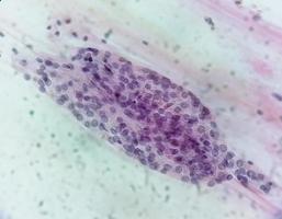 microscopisch visie van trichomonas vaginalis in pap smeren met weinig acuut opruiend cellen. foto