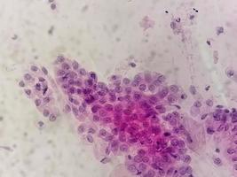 microscopisch visie van trichomonas vaginalis in pap smeren met weinig acuut opruiend cellen. foto
