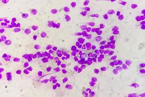 bloed smeren onder microscopie tonen chronisch lymfoblastisch leukemie of cll foto