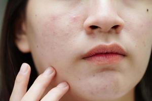 acne puistje en litteken op de huid gezicht, aandoeningen van de talgklieren, tienermeisje huidverzorging schoonheidsprobleem. foto