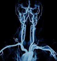 magnetisch resonantie angiogram van de hersenen vaatstelsel slagaders foto
