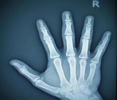 film röntgenstraal hand- ap visie tonen van mensen hand. foto