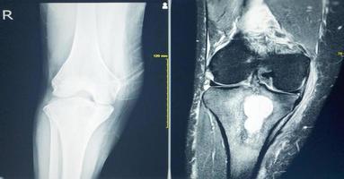 mri knie Rechtsaf knie pijn tb artritis of bot tumor. foto