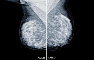 mammogram radiobeeldvorming voor de diagnose van borstkanker foto