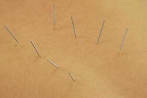 vrouw terug met staal naalden gedurende procedure van acupunctuur behandeling foto
