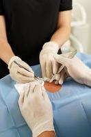 dokter en verpleegster gedurende moedervlek verwijdering dermatologisch chirurgie foto
