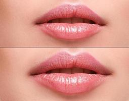 lippen voordat en na vergroting foto