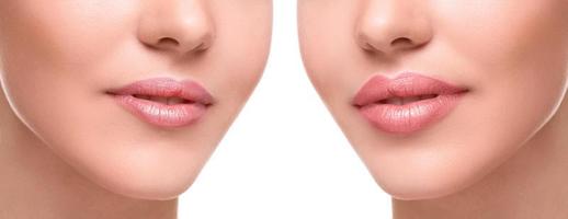 lippen voordat en na vergroting foto