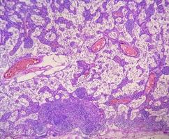 microfoto van maag adenocarcinoom. maag- adenocarcinoom. foto