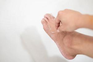 vrouw hand- richten naar haar pellen uit en gebarsten voet ten gevolge naar een allergisch chemisch reactie. foto