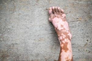 de oud Mens been met huid staat dat oorzaken verlies van melanine poseren binnenshuis. de voet model- in zwart tank top lijden van vitiligo wanorde. foto