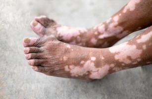 de oud Mens been met huid staat dat oorzaken verlies van melanine poseren binnenshuis. de voet model- in zwart tank top lijden van vitiligo wanorde. foto