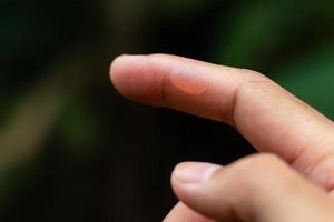 close-up van een vinger met een blaar erop foto
