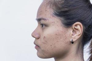 close-up van een jonge aziatische vrouw die zich zorgen maakt over haar gezicht als ze problemen heeft met de huid op haar gezicht. problemen met acne en littekens op de vrouwelijke huid. probleem huidverzorging en gezondheidsconcept. foto