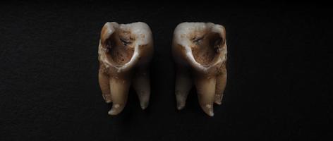 macro schot van een vervallen tanden tot wortel na extractie van tandarts. foto