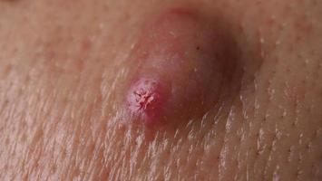 groot acne cyste abces of zweer gezwollen Oppervlakte binnen gezicht huid zakdoek. foto
