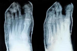 röntgenstraal van tenen, met verplaatst weinig vinger foto