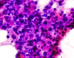 cytologisch studie van intra buik massa, spil cel sarcoom, positief voor kwaadaardig cellen. pleomorf ongedifferentieerd sarcoom, kwaadaardig vezelig histiocytoom. foto