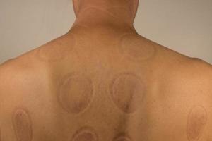 volwassen Mens dat had cupping behandeling gedaan Aan zijn terug voor pijn Verlichting foto