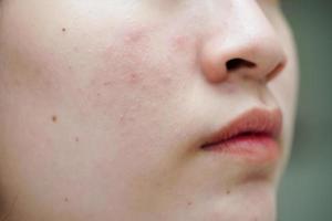 acne puistje en litteken op de huid gezicht, aandoeningen van de talgklieren, tienermeisje huidverzorging schoonheidsprobleem. foto