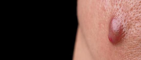 bacterieel huid infectie. groot acne cyste abces of zweer gezwollen Oppervlakte binnen gezicht huid zakdoek. met accumulatie van pus en bloed. macro schot van acne of dermatitis in de buurt mond Aan gezicht. huidverzorging. foto