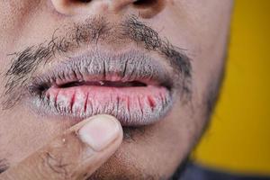 dichtbij omhoog van een jong mannen hand- droog lippen foto