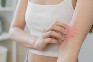 dermatologie Aziatisch jong vrouw, meisje allergie, allergisch reactie van atopisch, insect bijt Aan haar arm, hand- in krabben jeukend, jeuk rood plek of uitslag van huid. gezondheidszorg, behandeling van schoonheid. foto