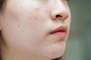 acne puistje en litteken op de huid gezicht, aandoeningen van de talgklieren, tienermeisje huidverzorging schoonheidsprobleem. foto