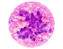 microfoto van prima naald- aspiratie cytologie van een long knobbel tonen adenocarcinoom, een type van niet klein cel carcinoom. foto