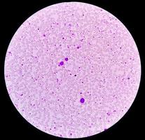 chronisch myeloïde leukemie of cml in versneld fase met trombocytose. chronisch myelogeen leukemie. foto