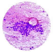 microfoto van prima naald- aspiratie cytologie van een long knobbel tonen adenocarcinoom, een type van niet klein cel carcinoom. foto